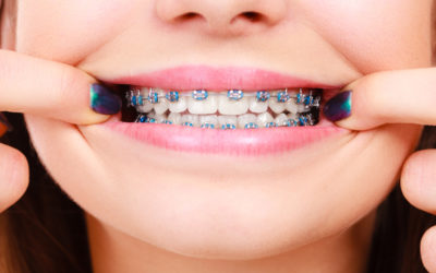 Choosing the Colors for Your Braces