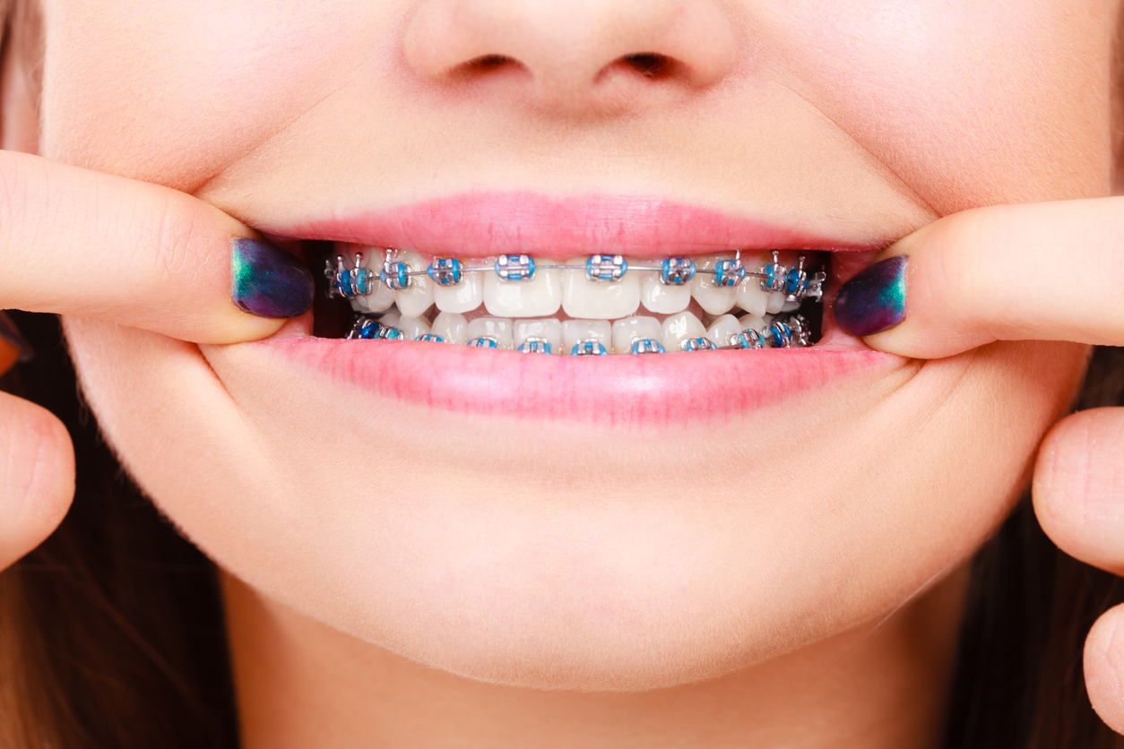 Dentist and orthodontist concept. Woman smile showing her white teeth with blue braces