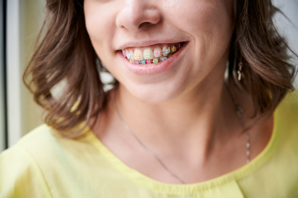 Close up of female patient smiling and showing brackets with multicolored rubber bands. Woman demonstrating wired braces with colorful dental rings. Concept of dentistry, orthodontics and stomatology.