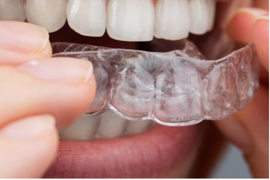 A picture containing clear mouthguard