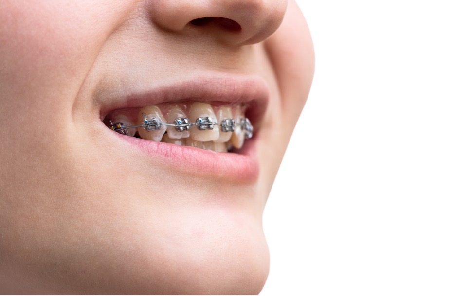 Close-up of a person with braces