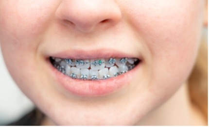 A close-up of a person's mouth with braces
