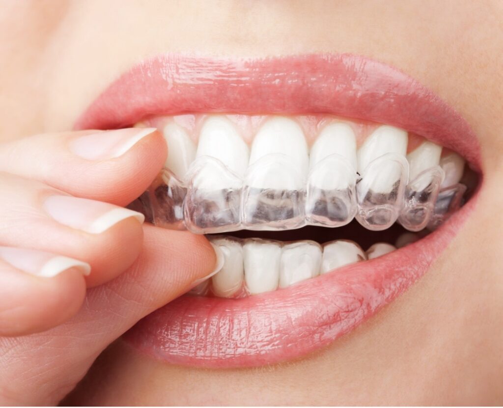 A close-up of a person's mouth, Invisalign (Clear Aligners) 