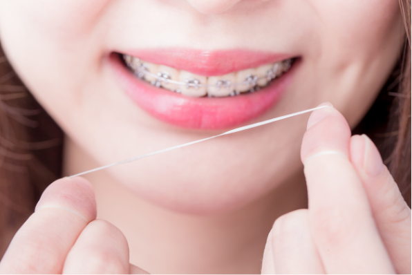 A close-up of a person with braces flossing their teeth, Why Dental Floss Gets Stuck with Braces and How to Prevent It
