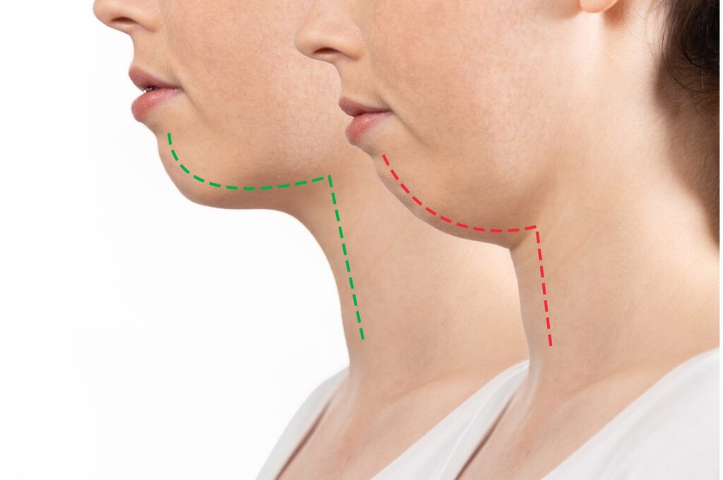 A person's neck with lines drawn on it, Understanding Overbites and Their Effects on Oral Health