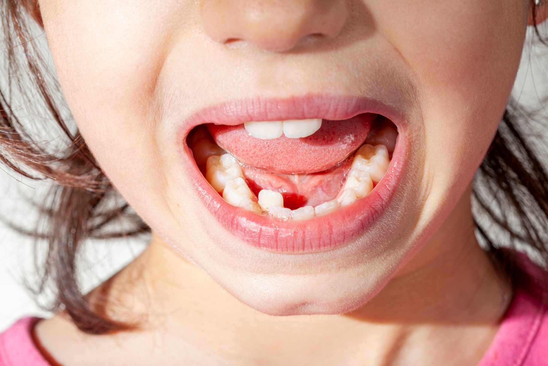 A close up of a child's mouth, Making Room for a Healthy Smile: Why Creating Space for Incoming Teeth Matters