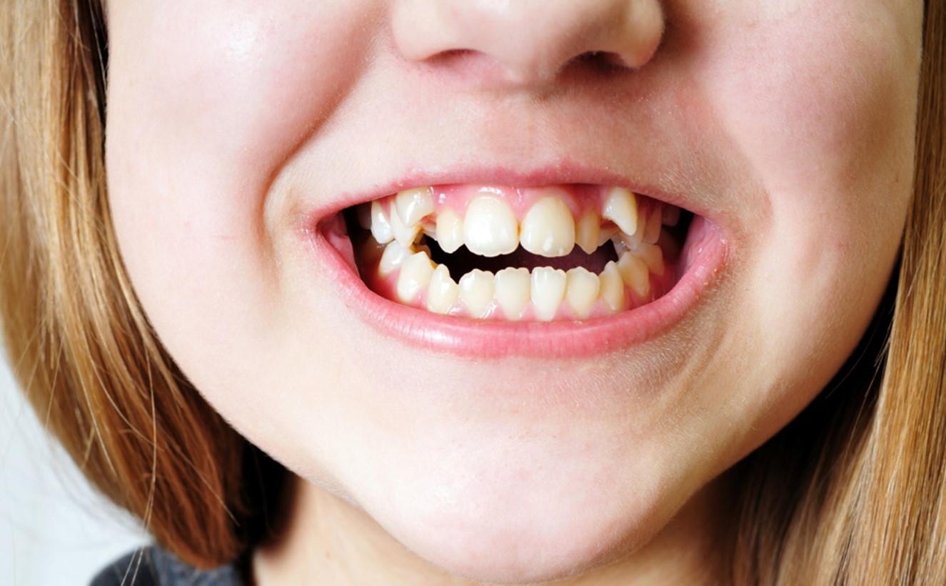 Close-up of a person's mouth showing her teeth, Spacing for Incoming Teeth