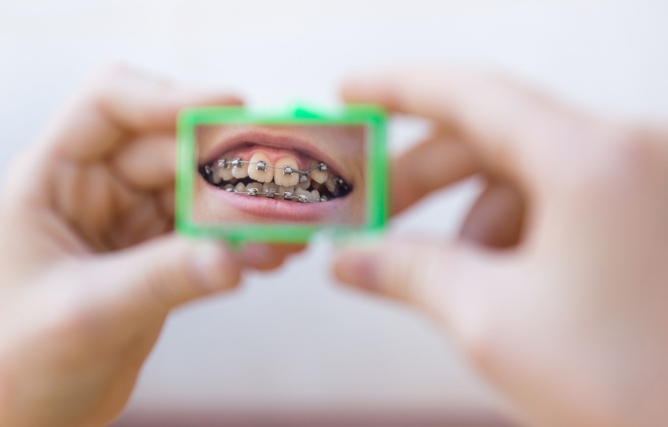 Protecting braces during sports, A persons mouth
