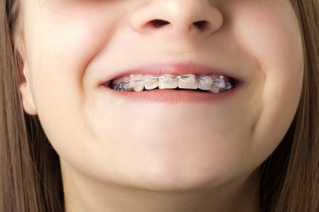 School-friendly orthodontic options, A child with braces smiling