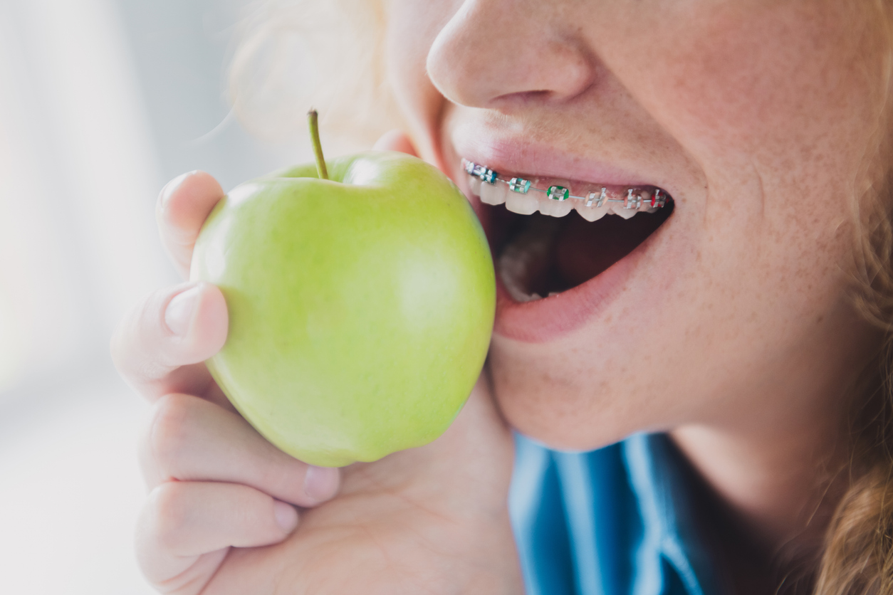 Cropped photo of nice young ginger girl bite apple eating teeth braces stomatology wear blue clothes Foods to Avoid with Braces for Kids and Teens: A February Guide , Cropped photo of nice young ginger girl bite apple eating teeth braces stomatology wear blue clothes.
