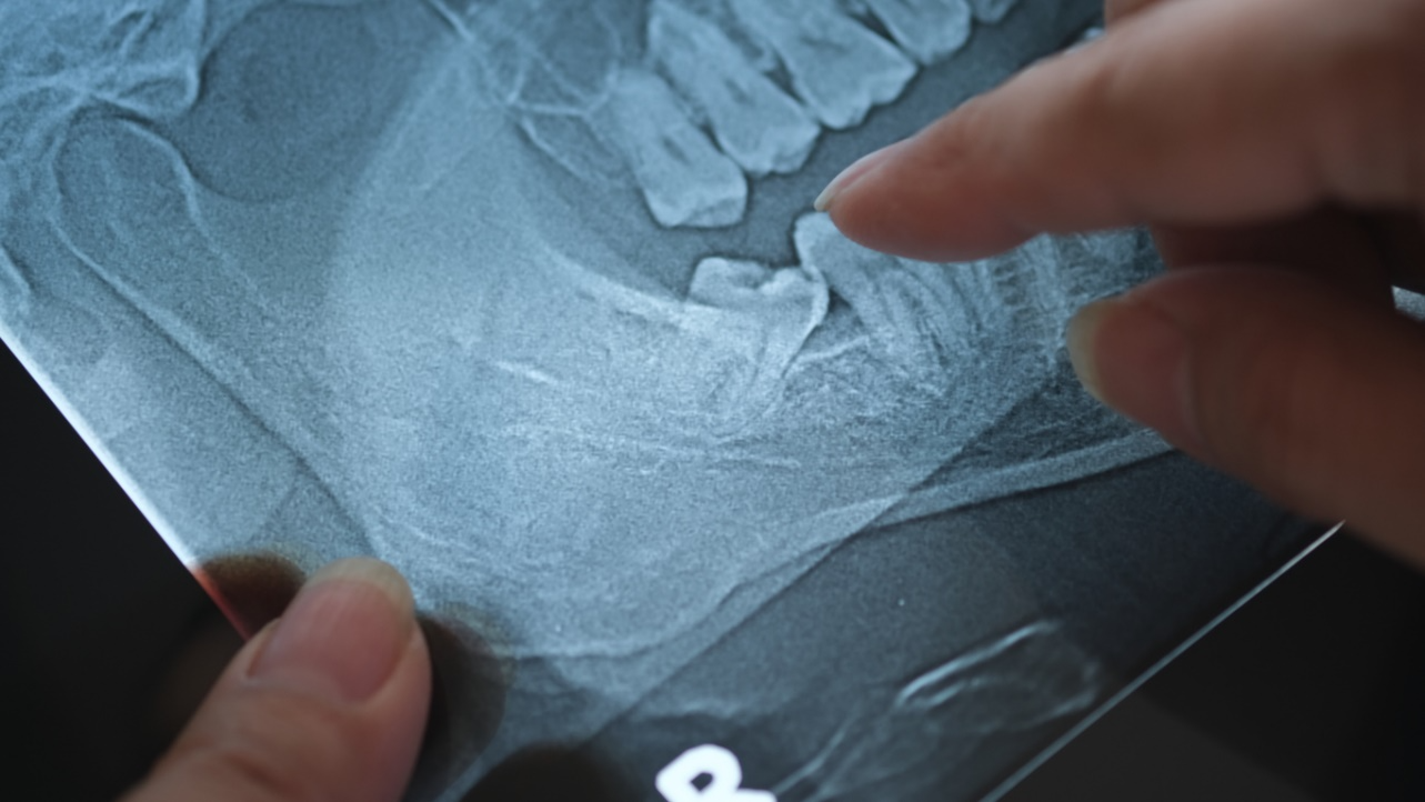 Dental X-ray showing a horizontally impacted wisdom tooth beneath the gums.